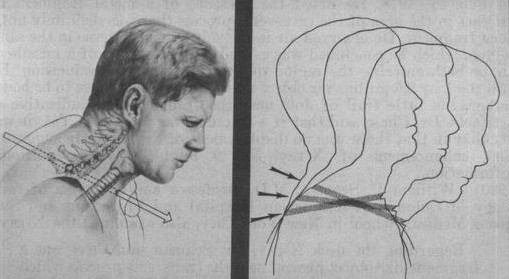 Skudvinklen gennem JFK's ryg og hals