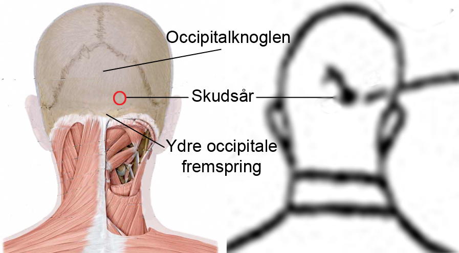 »det ydre occipitale fremspring«